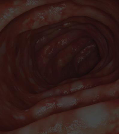 Ulcerative Colitis