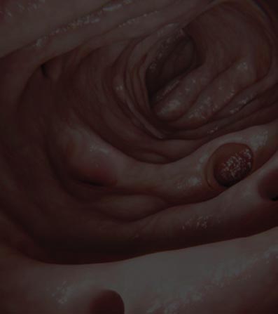 diverticulitis